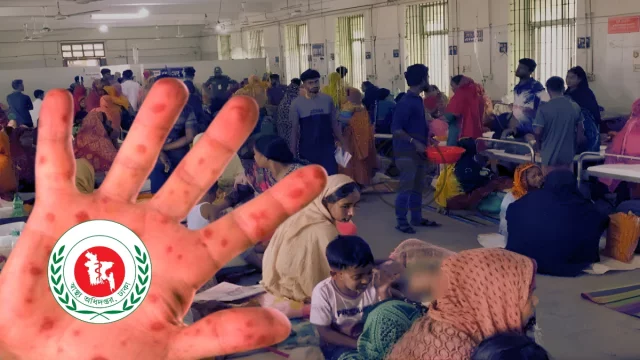 গত ২৪ ঘন্টায় হাম ও হামের উপসর্গ নিয়ে দেশে আরও ১১ শিশুর মৃত্যু